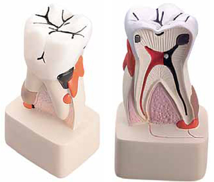 Dental Pathology Model